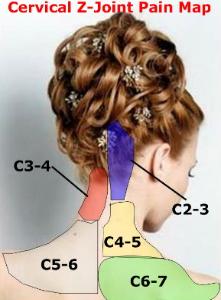 Боль в шейных суставах С2-С7.