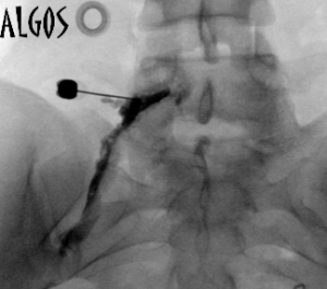 Spinal nerve infiltration