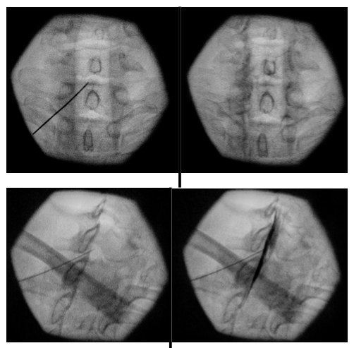 Infiltration péridurale cervicale avec Rx