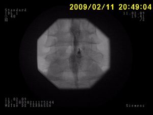 Lumbar epidural infiltration with Rx