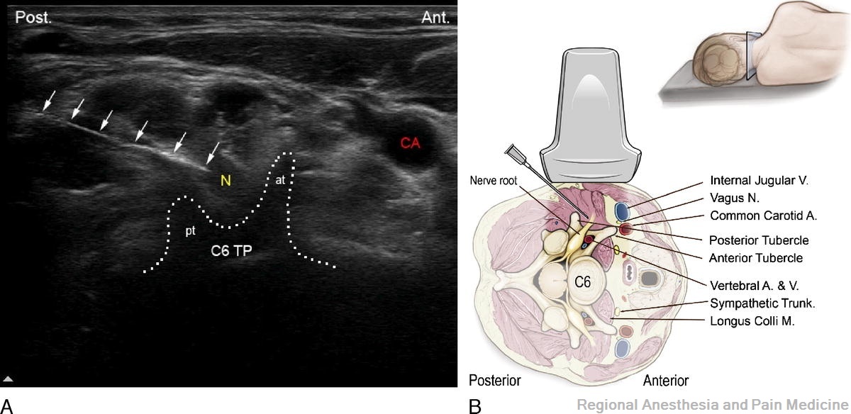 Inyección muscular cervical con ecografía